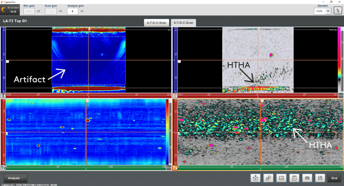 TFM and PCI for HTHA inspection using a dedicated PAUT probe and PWI excitation